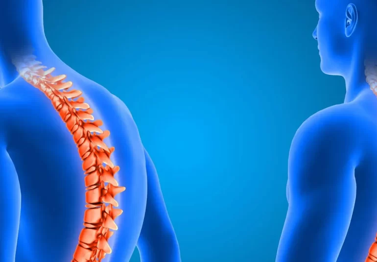 Dois diagramas anatômicos de figuras humanas em azul, com destaque para a coluna vertebral em laranja. A figura à esquerda exibe uma coluna curva, indicando uma condição como escoliose ou cifose, enquanto a figura à direita apresenta uma coluna reta, representando uma coluna normal ou saudável. A composição visual compara as diferenças entre uma coluna com curvatura anormal e uma coluna alinhada, útil para entender condições que afetam a saúde da coluna vertebral.