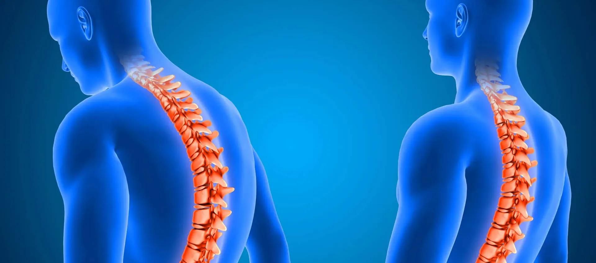 Dois diagramas anatômicos de figuras humanas em azul, com destaque para a coluna vertebral em laranja. A figura à esquerda exibe uma coluna curva, indicando uma condição como escoliose ou cifose, enquanto a figura à direita apresenta uma coluna reta, representando uma coluna normal ou saudável. A composição visual compara as diferenças entre uma coluna com curvatura anormal e uma coluna alinhada, útil para entender condições que afetam a saúde da coluna vertebral.